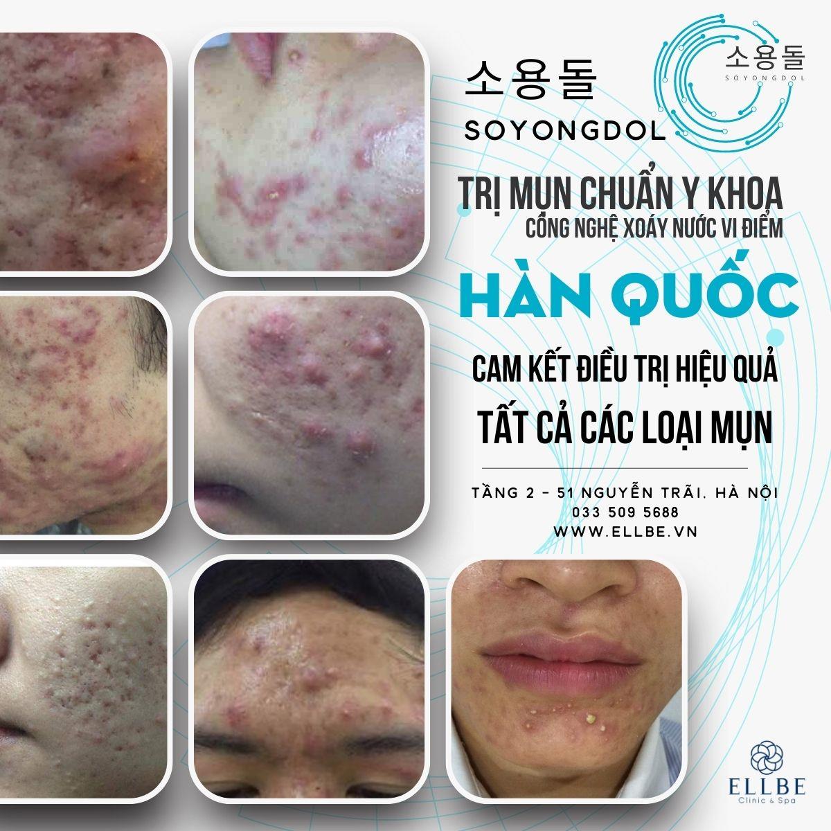 🌺 Công nghệ Xoáy nước vi điểm Soyongdol Hàn Quốc