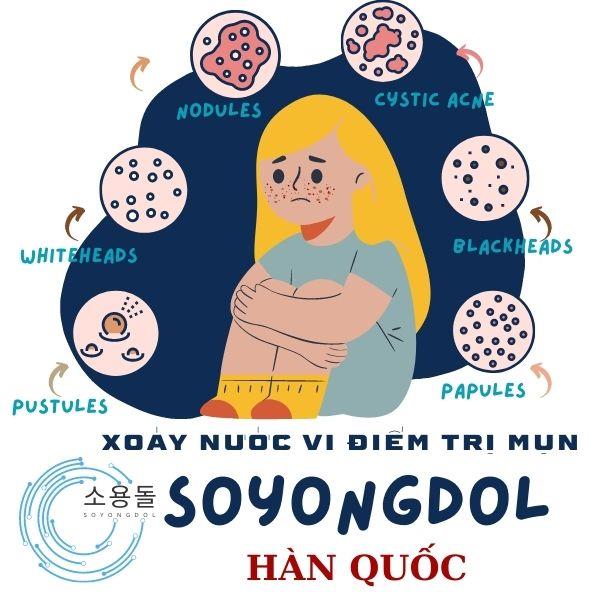 Dẫn nước vi điểm điều trị mụn Cấp độ 1 (1B)