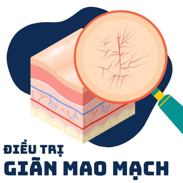 Phác Đồ Điều Trị Giãn Mao Mạch