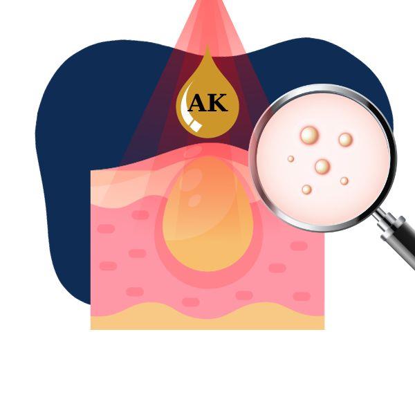 Điều Trị Mụn AK 1B
