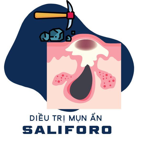 Lăn Lim Điều Trị Mụn Ẩn Saliforo