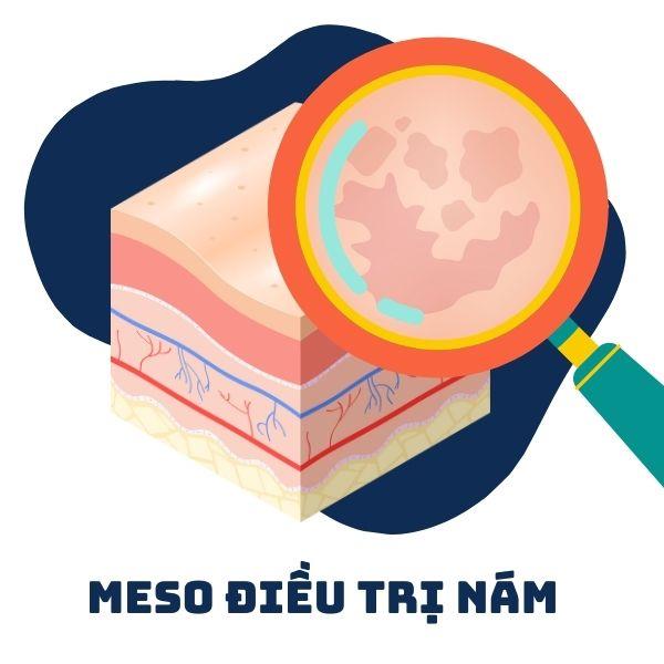 Meso Điều Trị Nám